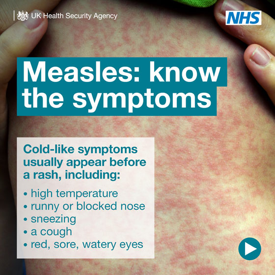 Measles: know the symptoms